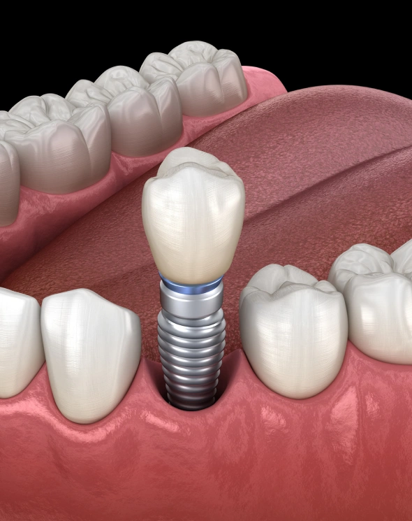 Dental implant illustration showing a metal screw post with ceramic crown replacing a missing tooth.