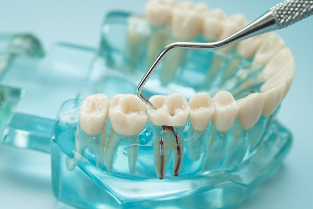Why Your Root Canal Needs a Crown to Actually Work