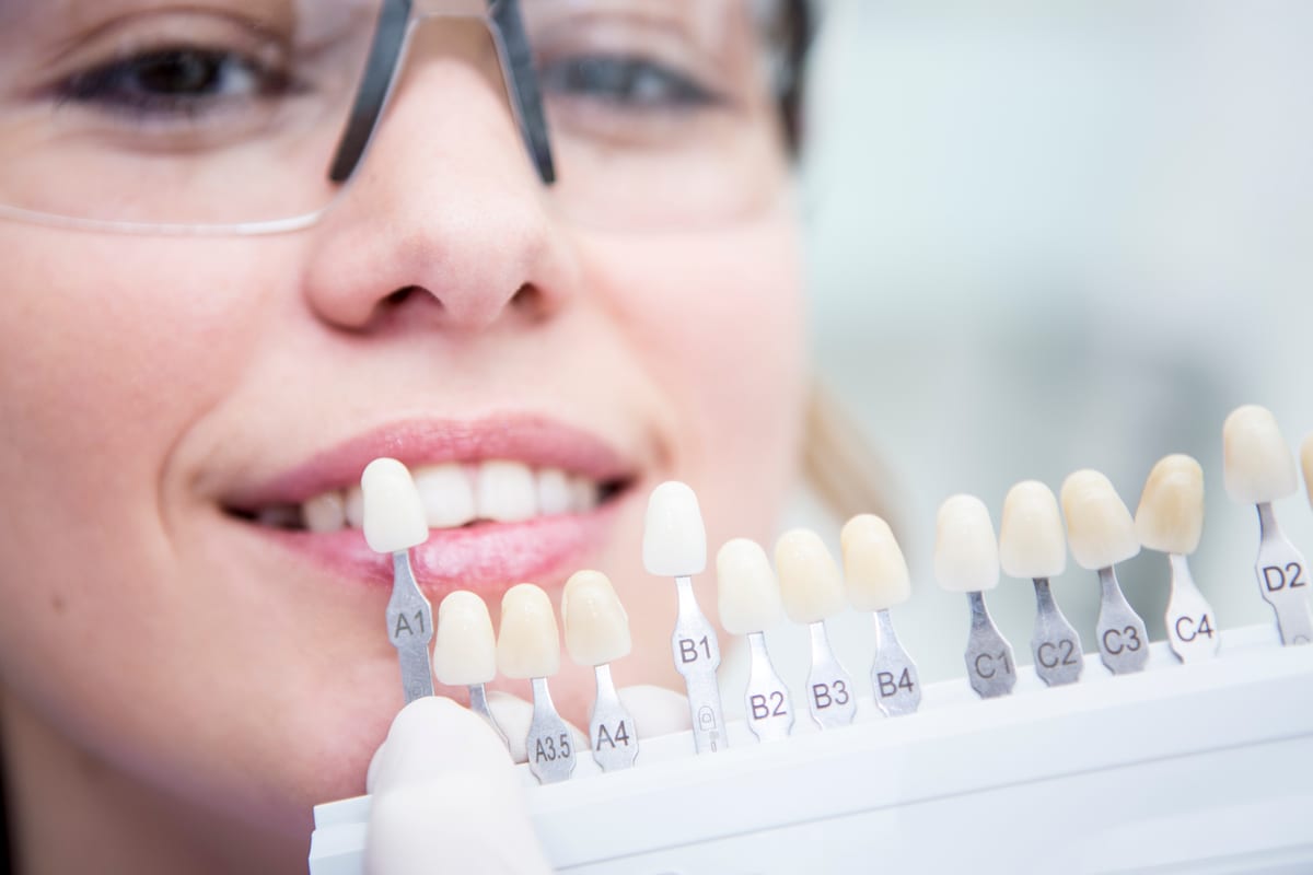 Why Modern Veneers Look Like Natural Teeth, Not Fake Ones