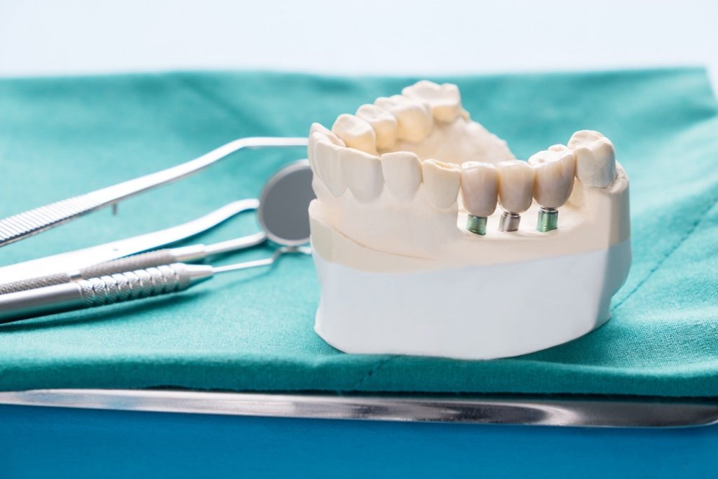 Implant Supported Dentures - Porcelain Model