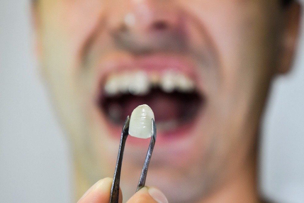Dental Emergency - Lost Filling