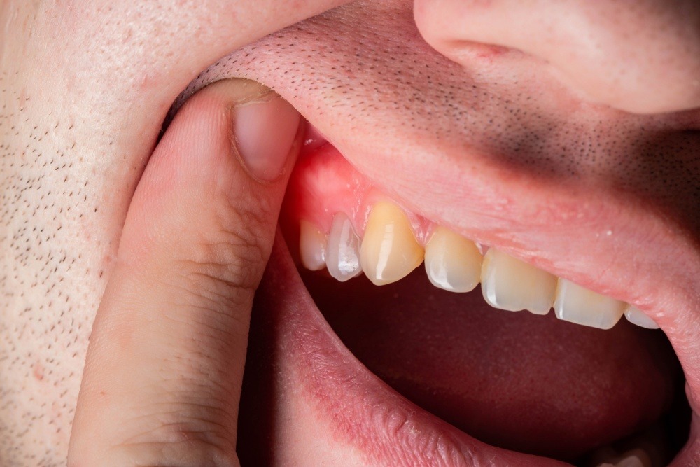 Man showing his tooth abscess