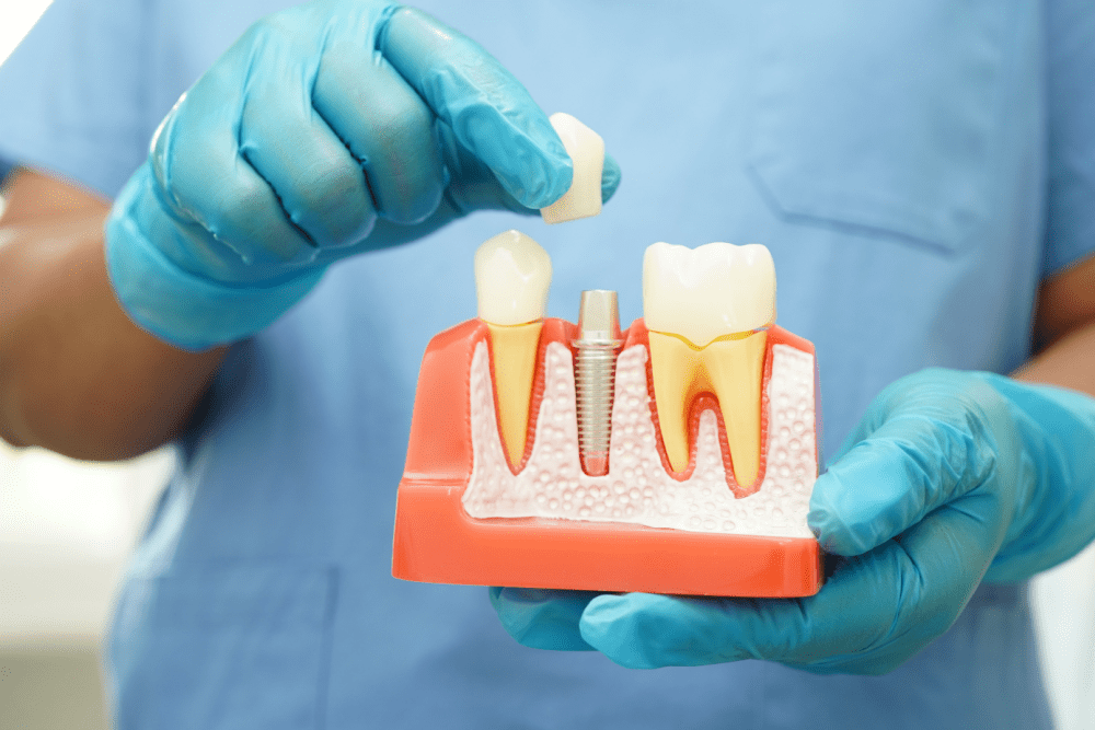 Model of dental implants