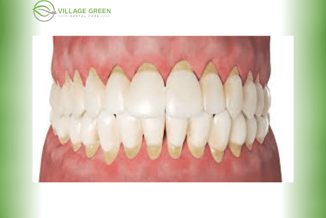 Mid-stage of Gum Disease (Moderate Periodontitis)
