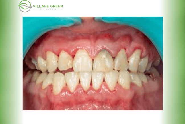 Early Stage of Gum Disease - Early Periodontitis