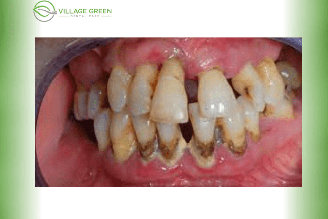 Advanced stage of gum disease symptoms