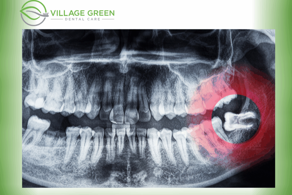 Simple Wisdom Tooth Extraction Non Surgical